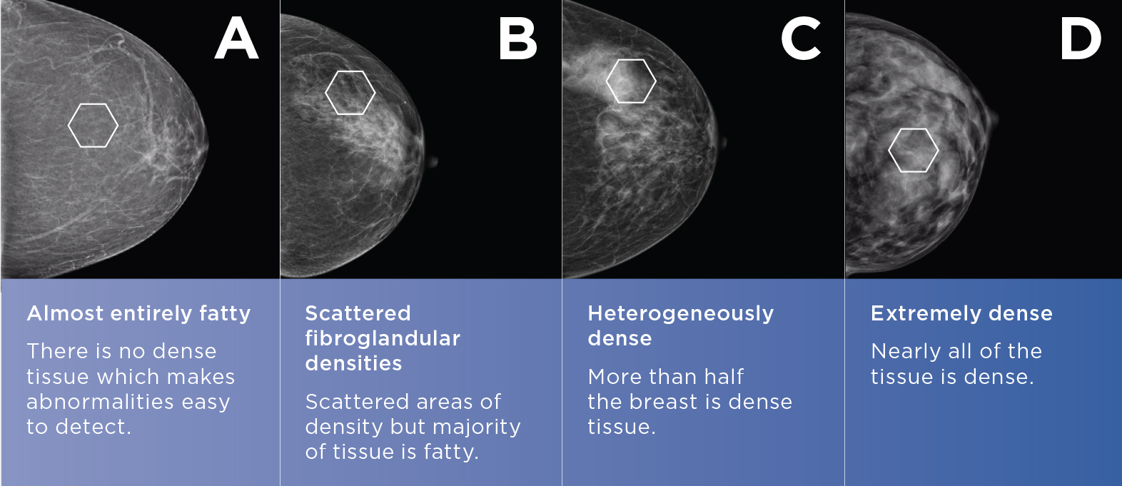 BREAST CANCER RISK AND BREAST DENSITY: IS AGE A FACTOR? - Mayfair ...