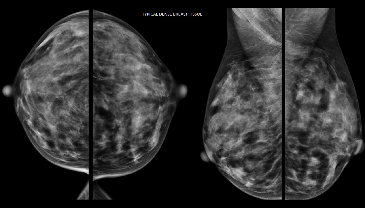 Breast Imaging: 3D Mammography (Tomosynthesis) - Breast Imaging