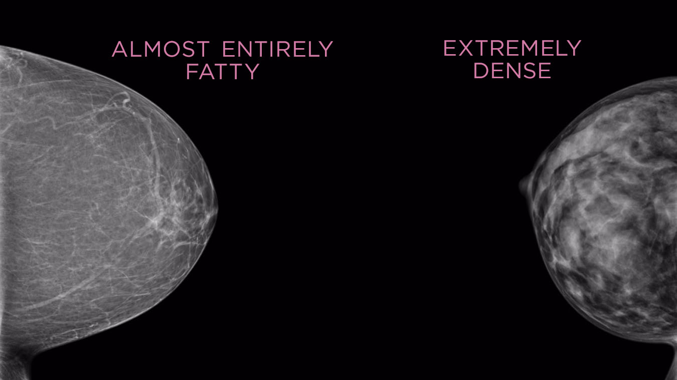 What should you know about breast density?
