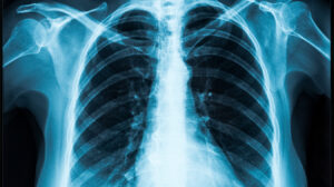 HOW DOES A CHEST X-RAY HELP DIAGNOSE BREATHING PROBLEMS? - Mayfair ...