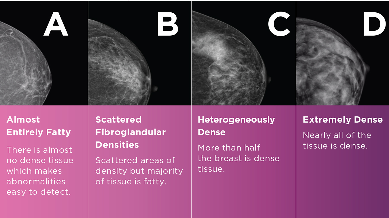 Bilateral mammogram shows mixed density glandular breast tissue with no